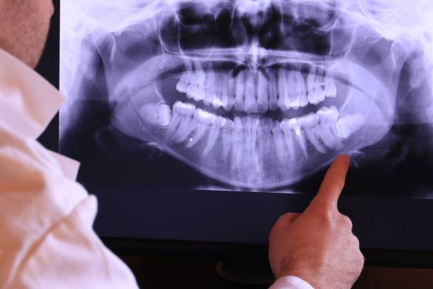 Best Emergency Treatment for Dental Infections or Abscesses in Nice, CA